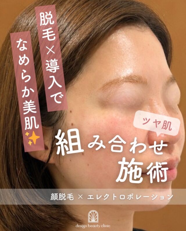 .
✨顔脱毛×エレクトロポレーション✨

「ムダ毛ケア」と「美肌ケア」を同時に叶えたい方におすすめ🌿

こちらは施術直後のお写真です📷

顔脱毛を行うことで産毛が減り、お肌のトーンアップやメイクノリの向上が期待できます💆‍♀️✨

さらに、エレクトロポレーションで美容成分をお肌の角質層まで届けることで、乾燥・くすみ・毛穴などのお悩みにアプローチ💎

脱毛後のお肌は刺激を受けやすいため、しっかり保湿ケアを行うことが大切です🫧
エレクトロポレーションを組み合わせることで、お肌を整えながらワンランク上の美肌を目指せます✨

✔ 顔の産毛が気になる
✔ 化粧ノリを良くしたい
✔ 毛穴や乾燥が気になる
✔ 透明感のある肌を目指したい

そんな方におすすめの組み合わせ治療です🌷

【エレクトロポレーション】
◾️初回：5,500円
◾️通常：6,600円

薬剤追加オプション
◾️ニキビ/美白/エイジング：3,300
◾️ベビースキン：9,800円

【全顔】
■初回：12,000円
■通常：16,500円
(※麻酔 別途3,000円)

⚠️DMでのお問い合わせはお受けしておりません
お問い合わせは、クリニックへ直接お電話をお願いいたします🌱

————————————

ACCESS：大阪府大阪市北区茶屋町15-8
茶屋町ビル2階
TEL：06-6743-4652
営業時間：10時〜17時
(最終受付時間：16時)
お問合せ受付時間：10時〜19時

#美容皮膚科 #美容外科 #導入保湿 #エレクトロポレーション #肌質改善