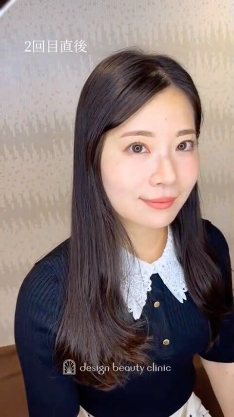 🪄
【毎日きれいな眉で過ごせる幸せ】

2回目の眉アートメイクでご来院いただきました。

1回目の施術後は、
「毎日きれいな眉で過ごせるようになった」
「メイクの時短になった」と嬉しいお声をいただきました。

さらに旅行のときは、
持っていくメイク道具が少なくて済んだり、
写真を撮るときもメイク直しを気にせず楽しめたり。

毎日を少しラクに、少し楽しくしてくれる眉アート
ご来院ありがとうございました！

➤施術名：アートメイク眉毛　1回33,000円（税込）
➤施術の説明：皮膚の浅い層を専用針で傷をつけて色素を入れることにより、皮膚を着色する施術です。
➤リスク・副作用：炎症症状(発赤・腫脹・熱感・疼痛)、内出血、痒み、アレルギー反応、感染等。

⚠️DMでのお問い合わせはお受けしておりません
お問い合わせは、クリニックへ直接お電話をお願いいたします

‥‥‥‥‥‥‥‥‥‥‥‥‥‥‥‥‥‥‥‥

■医療機関名
デザイン ビューティー クリニック

■ご予約方法
•WEB／LINE（プロフィールからリンクできます）
•電話

■電話番号（問い合わせ・予約）
メニューによって電話番号が異なります。

🌿アートメイク（大阪）
　06-6616-8095

🌿美容皮膚科メニュー（大阪）
　06-6743-4652

🌿アートメイク（東京）
　03-6263-2519

■店舗紹介
アートメイクは下記の4院どこでもお受けいただけます。

─ 梅田エリア ─

📍 梅田本院
大阪府大阪市北区茶屋町15-8 茶屋町ビル2階
営業時間：10:00〜19:00 ／ 定休日：不定休
診療：美容皮膚科 / アートメイク

📍 アートメイク梅田院
大阪府大阪市北区鶴野町2-1 梅田タナダビル1階
営業時間：10:00〜19:00 ／ 定休日：不定休
診療：アートメイク

─ 心斎橋・難波エリア ─

📍 アートメイク心斎橋院
大阪市中央区東心斎橋1-20-14 心斎橋エルナ岩崎ビル5階
営業�