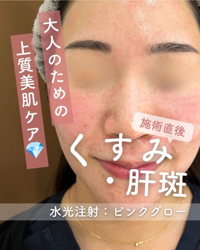 .

✨透明感あふれる、ワンランク上の素肌へ。✨

【ピンクグローキャンペーン中🎉】
こちらは施術直後のお写真です📷

鏡を見るたびに気になる、
シミ・肝斑・くすみ、そして肌全体の印象。

年齢や紫外線ダメージ、乾燥によって失われがちな透明感に、
ピンクグロー水光注射という新しい選択を💎

美容成分をお肌へ届けることで、
🤍みずみずしい潤い
🤍内側から輝くようなツヤ
🤍明るく澄んだ印象の肌へ
🤍ハリのある、なめらかな質感へ

「なんとなく顔色が冴えない」
「美白ケアを頑張っているのに物足りない」
そんな方にもおすすめの美肌治療です✨

メイクで隠すのではなく、
素肌そのものの美しさを引き出し、
毎日に自信を添えるお手伝いをいたします🌿

シミや肝斑、くすみなどのお悩みも、
お一人おひとりのお肌状態を丁寧に診察し、最適な治療をご提案いたします🤍

いつもピコトーニングを受けられてる方も、この機会に是非お試しください🕊

【ダウンタイムについて】
・赤みや膨隆疹は当日から2〜3日中に落ち着くことがほとんどです。
・点状出血は1〜2週間残る場合もあります。
・洗顔、スキンケア、メイクは翌日から可能（※詳しくはカウンセリングでお伝えします。）

💗 ピンクグロー とは？
肝斑・くすみ・乾燥を改善し、明るくツヤのある肌へ導く肌育製剤。
内側からふっくら、輝く素肌を育てます。

⚠️DMでのお問い合わせはお受けしておりません
お問い合わせは、クリニックへ直接お電話をお願いいたします🌱

————————————

ACCESS：大阪府大阪市北区茶屋町15-8
茶屋町ビル2階
TEL：06-6743-4652
営業時間：10時〜19時

#美容皮膚科 #美容クリニック #designbeautyclinic #デザインビューティークリニック #ピンクグロー