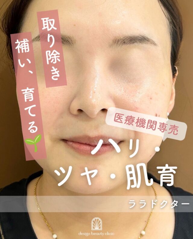 .

＼7月 特別キャンペーン実施中／
✨話題の「ララドクター」をご存じですか？✨

「美容医療に興味はあるけれど、何を選べばいいかわからない…」
そんな方にもおすすめしたい美肌施術です😊

🌿ララドクターは、お肌のコンディションを整えながら、うるおい・ツヤ・ハリのある健やかな肌へ導くことを目的としたスキンケア治療です。

こんなお悩みはありませんか？💭
✔️ 肌の乾燥やごわつきが気になる
✔️ ツヤのある明るい印象の肌を目指したい
✔️ キメを整えて、なめらかな肌になりたい
✔️ 肌管理を始めたいけれど、何を選べばいいかわからない

ララドクターは、お肌に美容成分を届けることで、肌本来のコンディションを整え、健やかな美肌づくりをサポートします✨

当院では、お一人おひとりのお肌の状態やお悩みを丁寧に確認し、最適な治療をご提案しております😊

美容医療が初めての方も、安心してご相談ください🌸

【ララドクター】
■初回：7,700円（税込）
■通常：12,800円（税込）
■3回コース：23,100円（税込）

⚠️DMでのお問い合わせはお受けしておりません
お問い合わせは、クリニックへ直接お電話をお願いいたします🌱

————————————

ACCESS：大阪府大阪市北区茶屋町15-8
茶屋町ビル2階
TEL：06-6743-4652
営業時間：10時〜17時
(最終受付時間：16時)
お問合せ受付時間：10時〜19時

#美容皮膚科 #美容外科 #美容クリニック #ララピール #ララドクター