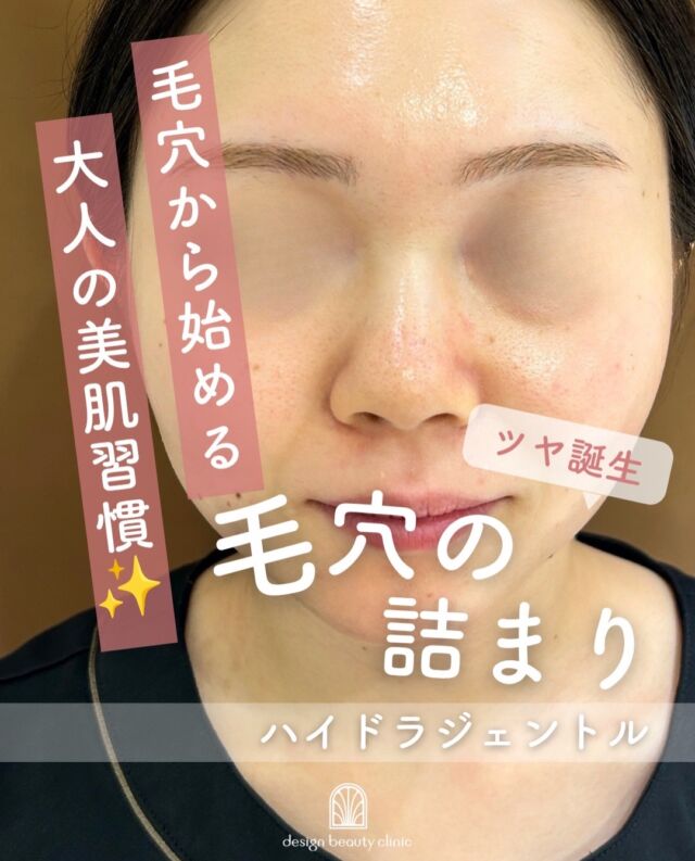 .
💧毛穴のお掃除、できていますか？✨

「ハイドラジェントル」は、水流の力で古い角質や毛穴の汚れ、余分な皮脂をやさしく洗い流す美容施術です🫧

✔️ 毛穴の黒ずみが気になる
✔️ お肌のザラつきを感じる
✔️ メイクのノリを良くしたい
✔️ お肌をすっきりリフレッシュしたい

そんな方におすすめです🌿

施術後は、お肌がつるんとなめらかな手触りになり、スキンケアもなじみやすく感じられる方が多くいらっしゃいます😊

美容医療が初めての方にも取り入れやすい人気の毛穴ケア✨
定期的なお手入れで、透明感のある健やかなお肌を目指しましょう💙

【ハイドラジェントル】
◾️初回：9,800円
◾️通常：13,800円

⚠️DMでのお問い合わせはお受けしておりません
お問い合わせは、クリニックへ直接お電話をお願いいたします🌱

————————————

ACCESS：大阪府大阪市北区茶屋町15-8
茶屋町ビル2階
TEL：06-6743-4652
営業時間：10時〜17時
(最終受付時間：16時)
お問合せ受付時間：10時〜19時

#美容皮膚科 #美容外科 #ハイドラジェントル #ツヤ肌 #毛穴洗浄