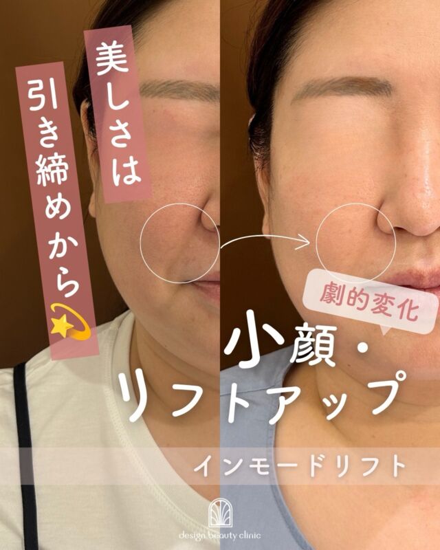 .
✨ 「最近、フェイスラインがぼんやりしてきた…」と感じていませんか？ ✨

鏡を見るたびに気になる、フェイスラインやあご下のもたつき。

インモードリフトは、高周波（RF）の力で
💎 肌を引き締め
💎 フェイスラインをすっきり整え
💎 ハリ・弾力アップを目指せる人気のリフトケアです。

「美容医療は初めてで少し不安…」
そんな方にも選ばれている施術です🌿

✔️ 切らないリフトケア
✔️ ダウンタイムが比較的少ない
✔️ 年齢によるたるみが気になり始めた方にもおすすめ

「なんとなく疲れて見える」
「写真を撮るとフェイスラインが気になる」
そんなお悩みをお持ちの方は、ぜひ一度ご相談ください🪞✨

無理なく、自然に。
あなた本来の美しさを引き出すお手伝いをいたします🤍

【料金案内】
インモードリフト（フォーマ＋ミニFX）
■初回　¥25,000
■通常　¥38,000
■3回コース　¥75,000

フォーマ（両頬）
■初回　¥12,800
■通常　¥20,000
■3回コース　¥38,400

ミニFX（両頬下またはアゴ下）
■初回　¥12,800
■通常　¥20,000
■3回コース　¥38,400

【施術について】
■施術時間：メニューにより異なります
■痛み：個人差はありますが、熱をじんわり感じる程度です
■メイク：当日から可能
■ダウンタイム：数日～1週間程度（赤み・腫れ・内出血が生じる場合があります）

💫リスク・副作用
内出血、腫れ、熱感、吸引性皮下出血、熱傷などが生じる場合があります。

⚠️DMでのお問い合わせはお受けしておりません。
お問い合わせは、クリニックへ直接お電話をお願いいたします🌱

————————————

ACCESS：大阪府大阪市北区茶屋町15-8
茶屋町ビル2階
TEL：06-6743-4652
営業時間：10時〜17時（最終受付16時）
お問合せ受付時間：10時〜19時

#美容皮膚科 #美容クリニック #デザインビューティークリニック #インモードリフト #ハイフ
