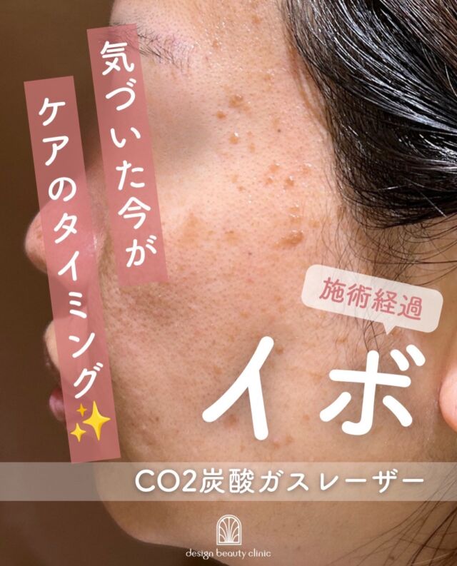 .
＼気になる「イボ」をすっきり✨／

こちらは施術直後、2週間後、1ヶ月後のお写真です📷

鏡を見るたび気になる小さなイボや盛り上がり。
「いつか取りたい」と思いながら、そのままにしていませんか？👀

当院では、**CO₂ガスレーザー（炭酸ガスレーザー）**を使用したイボ除去をご案内しています🌿

CO₂ガスレーザーは、レーザーの熱エネルギーで気になる部分をピンポイントに蒸散させ、イボを除去する治療です。

皮膚表面だけに作用するため、治癒も比較的早く、傷跡も目立ちにくいのが特徴です✨

✔️ 顔や首などの気になるイボに
✔️ 小さなイボをすっきりさせたい
✔️ メイクで隠すのが面倒
✔️ 肌をよりなめらかに見せたい

「こんな小さなイボでも取れるの？」という方も、まずはお気軽にご相談ください☺️

※適応や施術方法は、イボの種類・大きさ・状態などによって異なります。
※施術後は赤みやかさぶたなどのダウンタイムが生じる場合があります。

【料金案内】
☆1～5個：5,500円／個
☆6～10個：11,000円／個
☆軟膏1本：700円
※別途麻酔代：3,000円

・カウンセリング＋施術時間：約1時間
・施術中の痛み：表面麻酔使用のため、痛みはほとんどありません（個人差あり）
・ダウンタイム：2週間程度、軟膏の塗布が必要
・施術後のメイク：患部を避ければ当日からOK

⚠️DMでのお問い合わせはお受けしておりません。
お問い合わせは、クリニックへ直接お電話をお願いいたします🌱

————————————

ACCESS：大阪府大阪市北区茶屋町15-8
茶屋町ビル2階
TEL：06-6743-4652
営業時間：10時〜17時（最終受付16時）
お問合せ受付時間：10時〜19時

#イボ取り #ほくろ除去 #CO2レーザー #炭酸ガスレーザー #イボ除去