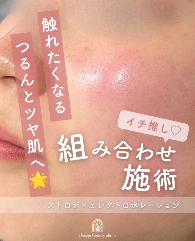.
✨ 毛穴・ざらつき・くすみ・乾燥に。
“つるんとツヤ肌”を目指す、贅沢な3STEP肌管理🫧

症例写真は施術直後のお写真です📷

🫧 ハイドラジェントル
水流の力で毛穴の汚れや古い角質をやさしくケア。
肌表面をすっきり整え、なめらかな肌へ。

✨ コラーゲンピール
お肌のハリ・ツヤをサポートし、明るくなめらかな印象へ。
「最近、肌の元気がない…」という方にもおすすめです。

💧 エレクトロポレーション
美容成分を電気パルスによって肌へ導入。
乾燥が気になるお肌にうるおいを与え、しっとりとした肌を目指します。

3つの施術を組み合わせることで、

「落とす」→「整える」→「届ける」

という流れで、お肌をトータルにケア✨

✔ 毛穴の黒ずみ・汚れが気になる
✔ 肌のざらつきが気になる
✔ くすんで見える
✔ ハリ・ツヤが欲しい
✔ 乾燥しやすく、うるおいが欲しい
✔ 大切な予定に向けて肌を整えたい

そんな方におすすめの肌管理メニューです🤍

定期的な肌メンテナンスとして取り入れて、
素肌に自信が持てる、なめらかでツヤのある肌へ。

「何をしたらいいかわからない」という方も、
お肌の状態やお悩みに合わせてご相談ください🌿

【エレクトロポレーション】
◾️初回：5,500円（税込）
◾️通常：6,600円（税込）
◾️3回コース(5,500円/1回)：16,500円(税込)
◾️10回コース(4,950円/1回)：49,500円(税込)

薬剤追加オプション
◾️ニキビ/美白/エイジング：3,300
◾️ベビースキン：9,800円

【ストロボフェイシャル】
◾️初回：19,600円（税込）
◾️通常：25,000円（税込）
◾️3回コース(7,700円/1回)：58,800円(税込)

⚠️DMでのお問い合わせはお受けしておりません
お問い合わせは、クリニックへ直接お電話をお願いいたします🌱

————————————

ACCESS：大阪府大阪市北区茶屋町15-8
茶屋町ビル2階
TEL：06-6743-4652
営業時間：10時〜17時
(最終受付時間：16時)
お問合せ受付時間：10時〜19時

#美容皮膚科 #美容外科 #美肌 #ツヤ肌 #肌質改善