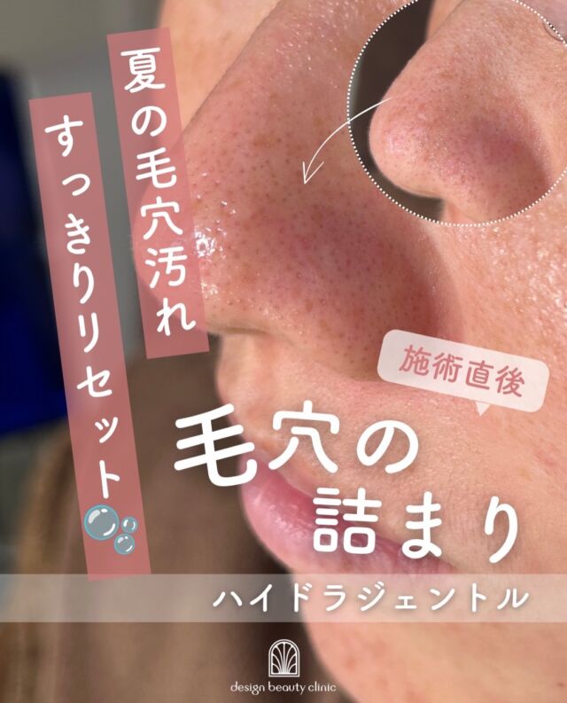 .
🫧☀️夏の毛穴ケア、始めませんか？☀️🫧

汗や皮脂が増えやすい夏は、
毛穴の詰まりや黒ずみ、ざらつきが気になりやすい季節👀💦

そんな夏のお肌におすすめなのが
ハイドラジェントル🫧

水流を利用して、毛穴にたまった皮脂や汚れ、古い角質を洗浄し、すっきりとなめらかな肌へ導きます✨

施術直後には、
「つるつるになった！」
「肌が明るく見える！」
「毛穴がすっきりした！」
と感じる方も多くいらっしゃいます🌿

夏こそ、毎日の洗顔だけでは落としきれない汚れをケアして、
毛穴からすっきり、爽やかな素肌へ🫧✨

気になる方はぜひお気軽にご相談ください☺️

【ハイドラジェントル】
◾️初回：9,800円
◾️通常：13,800円

⚠️DMでのお問い合わせはお受けしておりません
お問い合わせは、クリニックへ直接お電話をお願いいたします🌱

————————————

ACCESS：大阪府大阪市北区茶屋町15-8
茶屋町ビル2階
TEL：06-6743-4652
営業時間：10時〜17時
(最終受付時間：16時)
お問合せ受付時間：10時〜19時

#美容皮膚科 #美容外科 #ハイドラジェントル #ツヤ肌 #毛穴洗浄