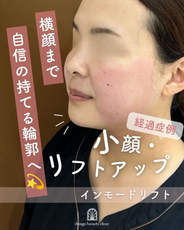 .
📸「最近、写真を見て顔が大きく見える…」
そんな変化、感じていませんか？

📍こちらはインモードリフト5回施術の経過症例です。

実は年齢とともに気になりやすいのが、
頬からフェイスラインにかけての“顔の余白”。

インモードリフトは、
気になる部分にアプローチしながら
すっきりとした輪郭を目指す美容医療です✨

正面だけでなく、
横顔やふとした瞬間の印象まで美しく。

「痩せた？」と言われるような
自然なすっきり感を目指したい方におすすめです🤍

大きく変えすぎず、
今の自分をもっと好きになれるフェイスラインへ。

【料金案内】
インモードリフト（フォーマ＋ミニFX）
■初回　¥25,000
■通常　¥38,000
■3回コース　¥75,000

フォーマ（両頬）
■初回　¥12,800
■通常　¥20,000
■3回コース　¥38,400

ミニFX（両頬下またはアゴ下）
■初回　¥12,800
■通常　¥20,000
■3回コース　¥38,400

【施術について】
■施術時間：メニューにより異なります
■痛み：個人差はありますが、熱をじんわり感じる程度です
■メイク：当日から可能
■ダウンタイム：数日～1週間程度（赤み・腫れ・内出血が生じる場合があります）

💫リスク・副作用
内出血、腫れ、熱感、吸引性皮下出血、熱傷などが生じる場合があります。

⚠️DMでのお問い合わせはお受けしておりません。
お問い合わせは、クリニックへ直接お電話をお願いいたします🌱

————————————

ACCESS：大阪府大阪市北区茶屋町15-8
茶屋町ビル2階
TEL：06-6743-4652
営業時間：10時〜17時（最終受付16時）
お問合せ受付時間：10時〜19時

#美容皮膚科 #美容クリニック #デザインビューティークリニック #インモードリフト #ハイフ