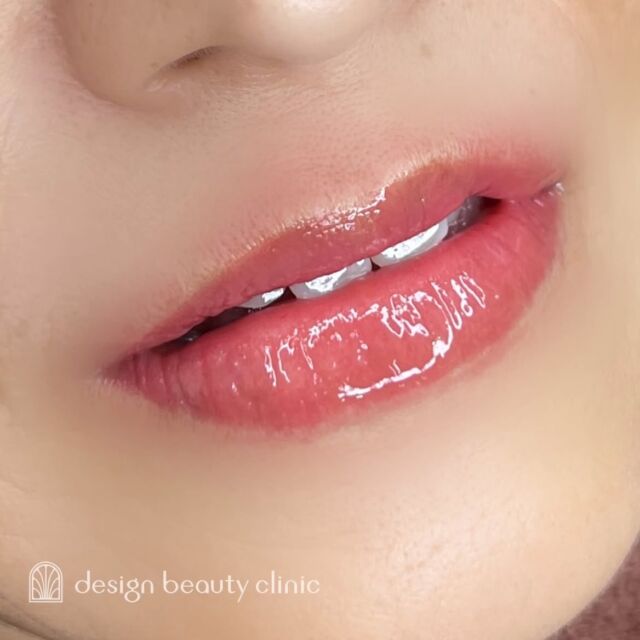 💋
■お悩み・ご希望：
お悩み：くすみが気になる
ご希望：くすみを改善したい

■施術内容：
リップアートメイク

お写真ご協力ありがとうございました🕊️

➤施術名：アートメイクリップ　1回44,000円（税込）
➤施術の説明：皮膚の浅い層を専用針で傷をつけて色素を入れることにより、皮膚を着色する施術です。
➤リスク・副作用：炎症症状(発赤・腫脹・熱感・疼痛)、内出血、痒み、アレルギー反応、感染等。

⚠️DMでのお問い合わせはお受けしておりません
お問い合わせは、クリニックへ直接お電話をお願いいたします

‥‥‥‥‥‥‥‥‥‥‥‥‥‥‥‥‥‥‥‥

■医療機関名
デザイン ビューティー クリニック

■ご予約方法
•WEB／LINE（プロフィールからリンクできます）
•電話

■電話番号（問い合わせ・予約）
地域・メニューによって電話番号が異なります。

🌿大阪 アートメイク
　06-6616-8095

🌿東京 アートメイク
　03-6263-2519

🌿名古屋 アートメイク
　052-433-7730

🌿大阪 美容皮膚科
　06-6743-4652

■店舗紹介
アートメイクは下記の5院どこでもお受けいただけます。

─ 梅田エリア ─

📍 梅田本院
大阪府大阪市北区茶屋町15-8 茶屋町ビル2階
営業時間：10:00〜19:00 ／ 定休日：不定休
診療：アートメイク / 美容皮膚科

📍 アートメイク梅田院
大阪府大阪市北区鶴野町2-1 梅田タナダビル1階
営業時間：10:00〜19:00 ／ 定休日：不定休
診療：アートメイク

─ 心斎橋・難波エリア ─

📍 アートメイク心斎橋院
大阪市中央区東心斎橋1-20-14 心斎橋エルナ岩崎ビル5階
営業時間：10:00〜19:00 ／ 定休日：不定休
診療：アートメイク

─ 東京エリア ─

📍アートメイク東京銀座院
東京都中央区銀座1丁目28-16 SUGIURA GINZA 7階
営業時間：10:00〜19:00 ／ 定休日：不定休
診療：アートメイク

─ 愛知エリア ─

📍アートメイク名古屋院
愛知県名古屋市西区名駅3-10-15 名駅三丁目ビル2階
営業時間：10:00〜19:00 ／ 定休日：不定休
診療：アートメイク

‥‥‥‥‥‥‥‥‥‥‥‥‥‥‥‥‥‥‥‥
#アートメイク #アートメイク眉 #アートメイクリップ #アートメイク大阪 #アートメイク東京
