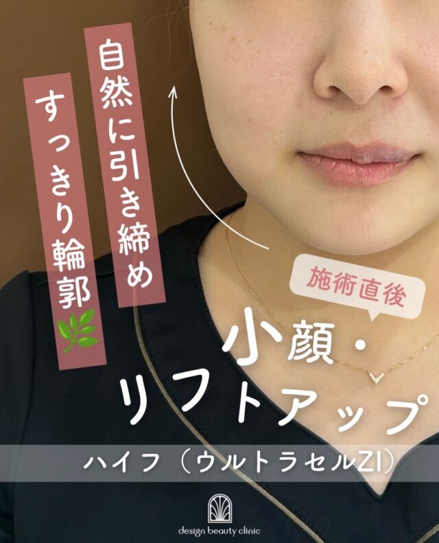 .
＼ただいまお得なキャンペーン中🎉／

「最近、フェイスラインがぼんやりしてきた…」
「肌のハリ感が気になる…」
そんな方に✨

💎 医療ハイフ〈ウルトラセルZi〉とは？

超音波のエネルギーを肌の深い層まで届け、
お肌の引き締めやフェイスラインのケアを目指す美容医療です💆‍♀️✨

表面だけではなく、肌の土台となる深い層へアプローチすることで、
すっきりとしたフェイスラインやハリのある印象へ🌿

こんなお悩みにおすすめ👇
✔️ フェイスラインをすっきりさせたい
✔️ たるみが気になってきた
✔️ 輪郭を引き締めたい
✔️ ハリ・弾力感がほしい
✔️ 切らずにたるみケアを始めたい

ウルトラセルZiは、照射部位や深さを調整しながら施術を行うため、
お一人おひとりのお肌状態やお悩みに合わせた治療が大切です🫧

「ハイフは初めてでちょっと不安…」という方も大丈夫☺️
まずはお気軽にご相談ください💐

美しく、自然な変化を目指したい方へ。
医療ハイフで、すっきりとした印象のフェイスラインへ✨

・カウンセリング＋施術時間： 1時間〜1時間半程
・施術中の痛み：骨に鈍痛の様な痛みが伴う場合あり
・ダウンタイム：2、３日から1週間前後、筋肉痛のような痛みが伴う場合あり
・施術後のメイク：当日からOK
・効果：たるみ、ほうれい線、しわ、二重顎、リフトアップ、小顔

⚠️DMでのお問い合わせはお受けしておりません
お問い合わせは、クリニックへ直接お電話をお願いいたします🌱

————————————

ACCESS：大阪府大阪市北区茶屋町15-8
茶屋町ビル2階
TEL：06-6743-4652
営業時間：10時〜17時（最終受付16時）
お問合せ受付時間：10時〜19時

#美容皮膚科  #ハイフ #HIFU #ウルトラセルzi #小顔