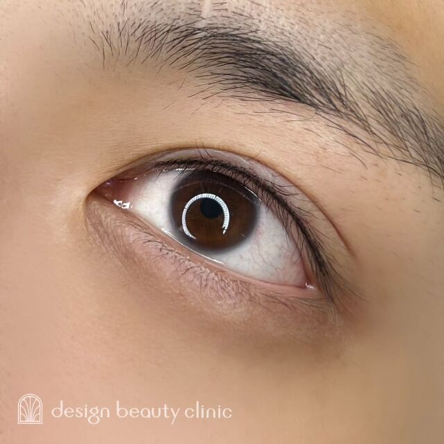 🪄
■お悩み・ご希望：
ご希望：目元をはっきりさせたい

■施術内容：
アイラインアートメイク

お写真ご協力ありがとうございました🕊️

➤施術名：アートメイクアイライン　1回22,000円（税込）
➤施術の説明：皮膚の浅い層を専用針で傷をつけて色素を入れることにより、皮膚を着色する施術です。
➤リスク・副作用：炎症症状(発赤・腫脹・熱感・疼痛)、内出血、痒み、アレルギー反応、感染等。

⚠️DMでのお問い合わせはお受けしておりません
お問い合わせは、クリニックへ直接お電話をお願いいたします

‥‥‥‥‥‥‥‥‥‥‥‥‥‥‥‥‥‥‥‥

■医療機関名
デザイン ビューティー クリニック

■ご予約方法
•WEB／LINE（プロフィールからリンクできます）
•電話

■電話番号（問い合わせ・予約）
地域・メニューによって電話番号が異なります。

🌿大阪 アートメイク
　06-6616-8095

🌿東京 アートメイク
　03-6263-2519

🌿名古屋 アートメイク
　052-433-7730

🌿大阪 美容皮膚科
　06-6743-4652

■店舗紹介
アートメイクは下記の5院どこでもお受けいただけます。

─ 梅田エリア ─

📍 梅田本院
大阪府大阪市北区茶屋町15-8 茶屋町ビル2階
営業時間：10:00〜19:00 ／ 定休日：不定休
診療：アートメイク / 美容皮膚科

📍 アートメイク梅田院
大阪府大阪市北区鶴野町2-1 梅田タナダビル1階
営業時間：10:00〜19:00 ／ 定休日：不定休
診療：アートメイク

─ 心斎橋・難波エリア ─

📍 アートメイク心斎橋院
大阪市中央区東心斎橋1-20-14 心斎橋エルナ岩崎ビル5階
営業時間：10:00〜19:00 ／ 定休日：不定休
診療：アートメイク

─ 東京エリア ─

📍アートメイク東京銀座院
東京都中央区銀座1丁目28-16 SUGIURA GINZA 7階
営業時間：10:00〜19:00 ／ 定休日：不定休
診療：アートメイク

─ 愛知エリア ─

📍アートメイク名古屋院
愛知県名古屋市西区名駅3-10-15 名駅三丁目ビル2階
営業時間：10:00〜19:00 ／ 定休日：不定休
診療：アートメイク

‥‥‥‥‥‥‥‥‥‥‥‥‥‥‥‥‥‥‥‥
#アートメイク #アートメイク眉 #アートメイクリップ #アートメイク大阪 #アートメイク東京
