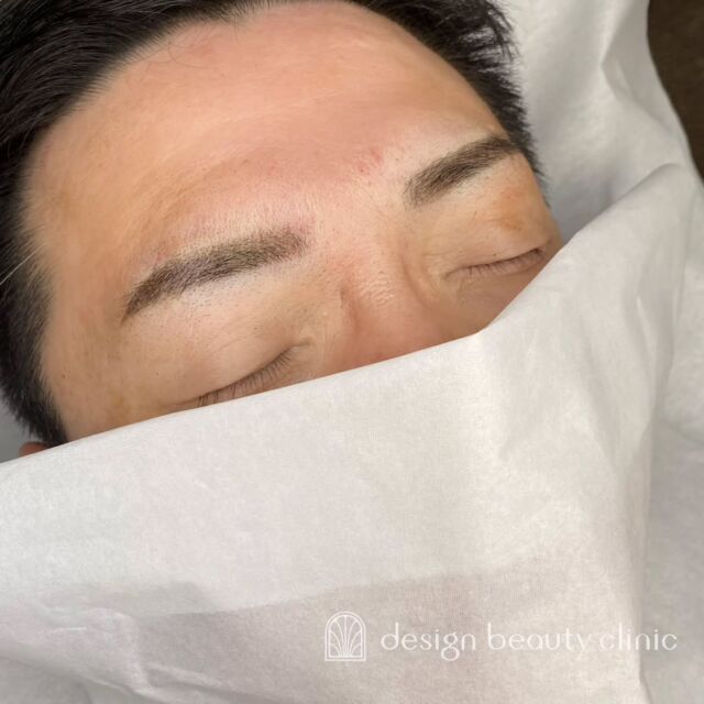 🪄
■お悩み・ご希望：
お悩み：他クリニックのリタッチ
ご希望：形の左右差を整えて、バランス良く整えて欲しい

■施術内容：
パウダー(2D)

お写真ご協力ありがとうございました🕊️

➤施術名：アートメイク眉毛　1回33,000円（税込）
➤施術の説明：皮膚の浅い層を専用針で傷をつけて色素を入れることにより、皮膚を着色する施術です。
➤リスク・副作用：炎症症状(発赤・腫脹・熱感・疼痛)、内出血、痒み、アレルギー反応、感染等。

⚠️DMでのお問い合わせはお受けしておりません
お問い合わせは、クリニックへ直接お電話をお願いいたします

‥‥‥‥‥‥‥‥‥‥‥‥‥‥‥‥‥‥‥‥

■医療機関名
デザイン ビューティー クリニック

■ご予約方法
•WEB／LINE（プロフィールからリンクできます）
•電話

■電話番号（問い合わせ・予約）
地域・メニューによって電話番号が異なります。

🌿大阪 アートメイク
　06-6616-8095

🌿東京 アートメイク
　03-6263-2519

🌿名古屋 アートメイク
　052-433-7730

🌿大阪 美容皮膚科
　06-6743-4652

■店舗紹介
アートメイクは下記の5院どこでもお受けいただけます。

─ 梅田エリア ─

📍 梅田本院
大阪府大阪市北区茶屋町15-8 茶屋町ビル2階
営業時間：10:00〜19:00 ／ 定休日：不定休
診療：アートメイク / 美容皮膚科

📍 アートメイク梅田院
大阪府大阪市北区鶴野町2-1 梅田タナダビル1階
営業時間：10:00〜19:00 ／ 定休日：不定休
診療：アートメイク

─ 心斎橋・難波エリア ─

📍 アートメイク心斎橋院
大阪市中央区東心斎橋1-20-14 心斎橋エルナ岩崎ビル5階
営業時間：10:00〜19:00 ／ 定休日：不定休
診療：アートメイク

─ 東京エリア ─

📍アートメイク東京銀座院
東京都中央区銀座1丁目28-16 SUGIURA GINZA 7階
営業時間：10:00〜19:00 ／ 定休日：不定休
診療：アートメイク

─ 愛知エリア ─

📍アートメイク名古屋院
愛知県名古屋市西区名駅3-10-15 名駅三丁目ビル2階
営業時間：10:00〜19:00 ／ 定休日：不定休
診療：アートメイク

‥‥‥‥‥‥‥‥‥‥‥‥‥‥‥‥‥‥‥‥
#アートメイク #アートメイク眉 #アートメイクリップ #アートメイク大阪 #アートメイク東京