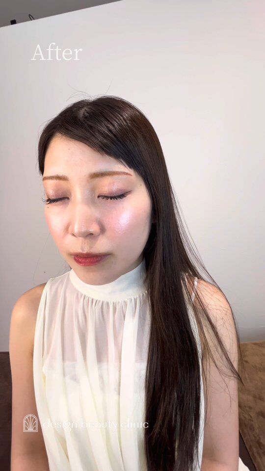 🪄
【理想の眉を自分に似合う形に】

「もともと興味があって、友達からいいよって聞いて」
そんなきっかけでご来院くださいました。

今回のご希望は、
明るめの色味で、少し細めのデザイン。

なりたいイメージを大切にしながら、
骨格やお顔立ちに合わせて一緒にデザインしていきます。

仕上がりにも「満足です」と嬉しいお言葉をいただきました。

あなたに似合う、理想の眉を一緒に見つけてみませんか？

➤施術名：アートメイク眉毛　1回33,000円（税込）
➤施術の説明：皮膚の浅い層を専用針で傷をつけて色素を入れることにより、皮膚を着色する施術です。
➤リスク・副作用：炎症症状(発赤・腫脹・熱感・疼痛)、内出血、痒み、アレルギー反応、感染等。

⚠️DMでのお問い合わせはお受けしておりません
お問い合わせは、クリニックへ直接お電話をお願いいたします

‥‥‥‥‥‥‥‥‥‥‥‥‥‥‥‥‥‥‥‥

■医療機関名
デザイン ビューティー クリニック

■ご予約方法
•WEB／LINE（プロフィールからリンクできます）
•電話

■電話番号（問い合わせ・予約）
地域・メニューによって電話番号が異なります。

🌿大阪 アートメイク
　06-6616-8095

🌿東京 アートメイク
　03-6263-2519

🌿名古屋 アートメイク
　052-433-7730

🌿大阪 美容皮膚科
　06-6743-4652

■店舗紹介
アートメイクは下記の5院どこでもお受けいただけます。

─ 梅田エリア ─

📍 梅田本院
大阪府大阪市北区茶屋町15-8 茶屋町ビル2階
営業時間：10:00〜19:00 ／ 定休日：不定休
診療：アートメイク / 美容皮膚科

📍 アートメイク梅田院
大阪府大阪市北区鶴野町2-1 梅田タナダビル1階
営業時間：10:00〜19:00 ／ 定休日：不定休
診療：アートメイク

─ 心斎橋・難波エリア ─

📍 アートメイク心斎橋院
大阪市中央区東心斎橋1-20-14 心斎橋エルナ岩崎ビル5階
営業時間：10:00〜19:00 ／ 定休日：不定休
診療：アートメイク

─ 東京エリア ─

📍アートメイク東京銀座院
東京都中央区銀座1丁目28-16 SUGIURA GINZA 7階
営業時間：10:00〜19:00 ／ 定休日：不定休
診療：アートメイク

─ 愛知エリア ─

📍アートメイク名古屋院
愛知県名古屋市西区名駅3-10-15 名駅三丁目ビル2階
営業時間：10:00〜19:00 ／ 定休日：不定休
診療：アートメイク

‥‥‥‥‥‥‥‥‥‥‥‥‥‥‥‥‥‥‥‥
#アートメイク #アートメイク眉 #アートメイクリップ #アートメイク大阪 #アートメイク東京