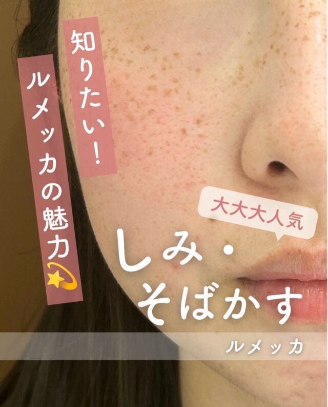 【秋こそルメッカで目指す、透明感のある肌へ🤍】

＼10月限定！秋のシミ治療キャンペーン実施中🍂／

シミ・そばかす・赤みなど、気になる肌悩みはありませんか？💭

ルメッカは、IPL（光治療）の一種で、さまざまな肌悩みにアプローチする美容施術です✨

🌿 ルメッカのポイント
・シミやそばかすが気になる方に
・肌の赤みや色ムラが気になる方に
・肌状態に合わせた美肌治療を検討したい方に

1回でも変化を感じることがありますが、肌悩みや状態によっては複数回の施術を検討することも大切です。

施術後は赤みやほてり、一時的にシミが濃く見えるなどの反応が出る場合があります。保湿と紫外線対策を心がけましょう☀️

お肌の状態に合わせた治療選びで、理想の肌を目指しませんか？

気になる方はお気軽にご相談ください🕊️

⚠️DMでのお問い合わせはお受けしておりません
お問い合わせは、クリニックへ直接お電話をお願いいたします🌱

————————————

ACCESS：大阪府大阪市北区茶屋町15-8
茶屋町ビル2階
TEL：06-6743-4652
営業時間：10時〜19時

#美容皮膚科 #美容クリニック #designbeautyclinic #デザインビューティークリニック #ルメッカ