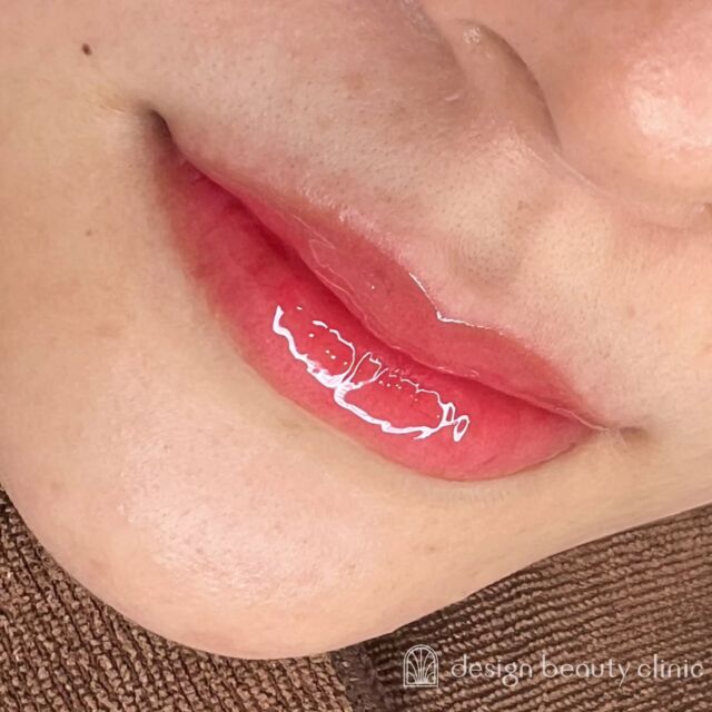 💋
■お悩み・ご希望：
お悩み：色がない
ご希望：血色を上げたい

■施術内容：
リップアートメイク

お写真ご協力ありがとうございました🕊️

➤施術名：アートメイクリップ　1回44,000円（税込）
➤施術の説明：皮膚の浅い層を専用針で傷をつけて色素を入れることにより、皮膚を着色する施術です。
➤リスク・副作用：炎症症状(発赤・腫脹・熱感・疼痛)、内出血、痒み、アレルギー反応、感染等。

⚠️DMでのお問い合わせはお受けしておりません
お問い合わせは、クリニックへ直接お電話をお願いいたします

‥‥‥‥‥‥‥‥‥‥‥‥‥‥‥‥‥‥‥‥

■医療機関名
デザイン ビューティー クリニック

■ご予約方法
•WEB／LINE（プロフィールからリンクできます）
•電話

■電話番号（問い合わせ・予約）
地域・メニューによって電話番号が異なります。

🌿大阪 アートメイク
　06-6616-8095

🌿東京 アートメイク
　03-6263-2519

🌿名古屋 アートメイク
　052-433-7730

🌿大阪 美容皮膚科
　06-6743-4652

■店舗紹介
アートメイクは下記の5院どこでもお受けいただけます。

─ 梅田エリア ─

📍 梅田本院
大阪府大阪市北区茶屋町15-8 茶屋町ビル2階
営業時間：10:00〜19:00 ／ 定休日：不定休
診療：アートメイク / 美容皮膚科

📍 アートメイク梅田院
大阪府大阪市北区鶴野町2-1 梅田タナダビル1階
営業時間：10:00〜19:00 ／ 定休日：不定休
診療：アートメイク

─ 心斎橋・難波エリア ─

📍 アートメイク心斎橋院
大阪市中央区東心斎橋1-20-14 心斎橋エルナ岩崎ビル5階
営業時間：10:00〜19:00 ／ 定休日：不定休
診療：アートメイク

─ 東京エリア ─

📍アートメイク東京銀座院
東京都中央区銀座1丁目28-16 SUGIURA GINZA 7階
営業時間：10:00〜19:00 ／ 定休日：不定休
診療：アートメイク

─ 愛知エリア ─

📍アートメイク名古屋院
愛知県名古屋市西区名駅3-10-15 名駅三丁目ビル2階
営業時間：10:00〜19:00 ／ 定休日：不定休
診療：アートメイク

‥‥‥‥‥‥‥‥‥‥‥‥‥‥‥‥‥‥‥‥
#アートメイク #アートメイク眉 #アートメイクリップ #アートメイク大阪 #アートメイク東京