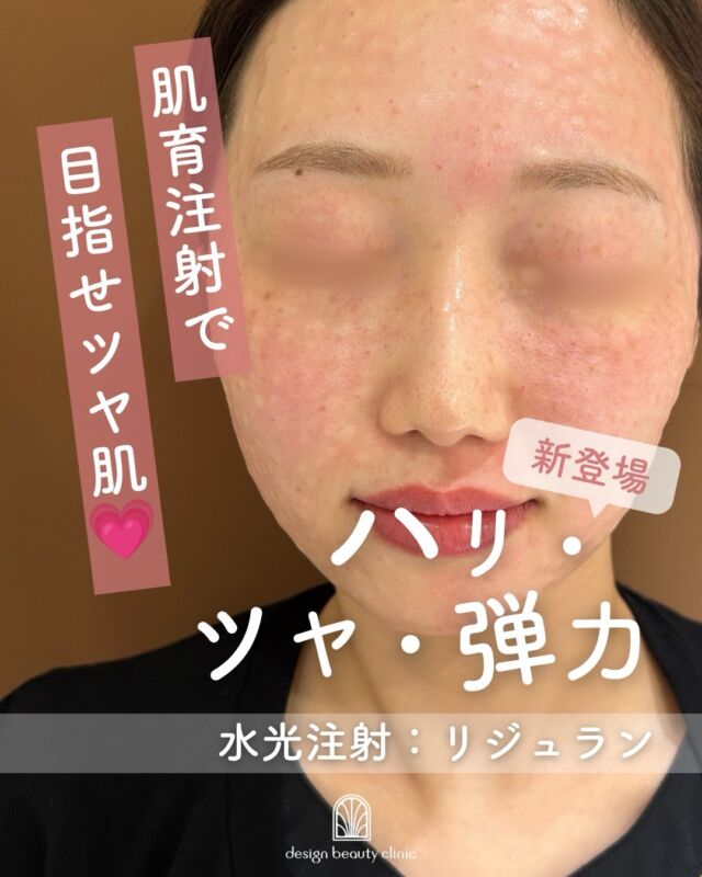 .
＼ 新メニューのご紹介🌷 ／
肌本来の美しさを目指す「リジュラン」💧

最近、肌のハリや弾力の低下、乾燥による小じわなどが気になりませんか？🤔

そんなお悩みをお持ちの方におすすめしたい美容施術のひとつが、リジュランです✨

このたび、当クリニックでもリジュランの取り扱いをスタートいたしました！👏💕

💎 リジュランってどんな施術？

リジュランは、サーモン由来のポリヌクレオチド（PN）を主成分とする製剤を使用し、肌のハリや弾力、キメなどの改善を目指す肌育治療です。

肌の表面的なケアだけでなく、肌そのもののコンディションを整えたい方に注目されています🌿

💗 こんなお悩みの方におすすめ
✔️ 肌のハリ・弾力が気になってきた
✔️ 乾燥による小じわが気になる
✔️ 肌のキメを整えたい
✔️ 以前より肌の元気がなく感じる
✔️ 年齢に合わせたエイジングケアを始めたい

年齢とともに変化するお肌に、今からできるスキンケアの選択肢を増やしてみませんか？☺️

リジュランが初めての方も、お肌のお悩みやご希望に合わせてご相談いただけます。

新しく導入したリジュランで、ハリ・ツヤのある健やかな肌を目指しましょう✨

気になる方は、お気軽にお問い合わせください📩

※効果の感じ方には個人差があります。施術には赤み・腫れ・内出血などのリスクがあります。適応や注意事項については、医師の診察時にご確認ください。

【リジュラン】
■水光注射（ハイコックス）
初回(2.7㏄)：32,000円
通常(2.7㏄)：41,000円
3回コース：96,000円(32,000円/1回)

■ドクター手打ち
通常(2.7㏄)：57,000円

※麻酔別途 3,000円

⚠️DMでのお問い合わせはお受けしておりません
お問い合わせは、クリニックへ直接お電話をお願いいたします🌱

————————————

ACCESS：大阪府大阪市北区茶屋町15-8
茶屋町ビル2階
TEL：06-6743-4652
営業時間：10時〜19時

#美容皮膚科 #美容クリニック #designbeautyclinic #デザインビューティークリニック #リジュラン